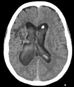 Sangramento Intraventricular visto em TC